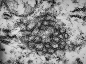 M,51y. | tubular convolution - scrotal sarcoma